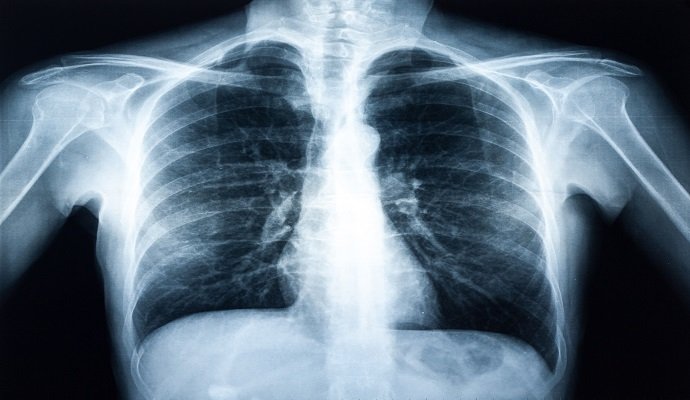 Researchers used locally run LLMs to interpret chest x-ray findings